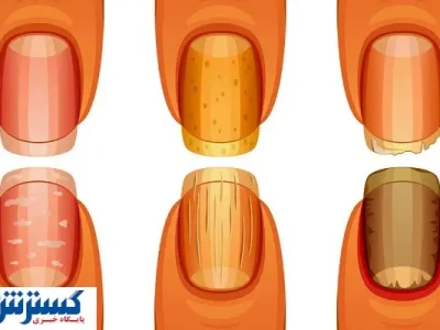 تشخیص سرطان ریه از روی ناخن ممکن شد