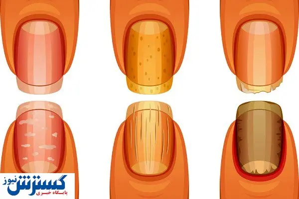 تشخیص سرطان ریه از روی ناخن ممکن شد