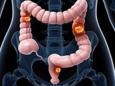 عوامل ابتلا به سرطان روده بزرگ را بشناسیم