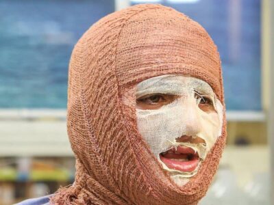 آیا بهبود کامل پس از سوختگی‌های عمیق امکان‌پذیر است؟