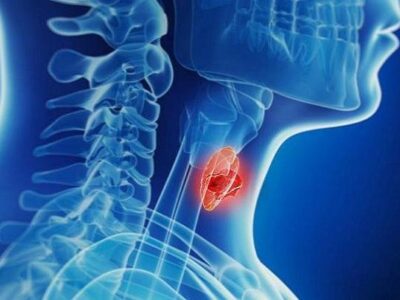 افزایش آمار تشخیص بدخیمی‌های تیروئیدی