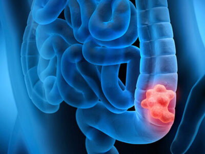 مصرف مشروبات الکلی خطر ابتلا به سرطان روده بزرگ را افزایش می‌دهد